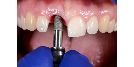 Causes of Dental Implant Failure