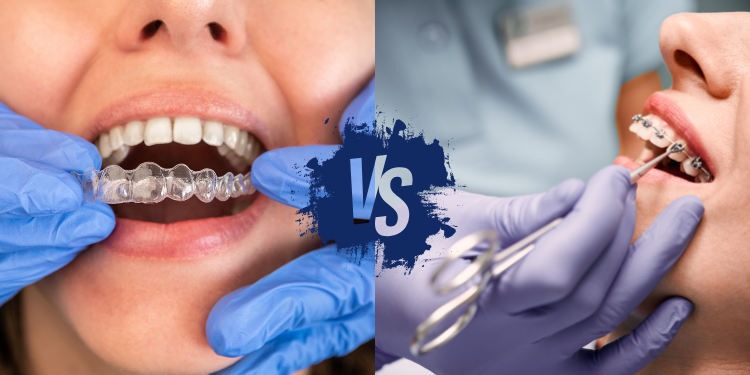 Aligners vs. traditional braces: A comparison of effectiveness, cost, and convenience